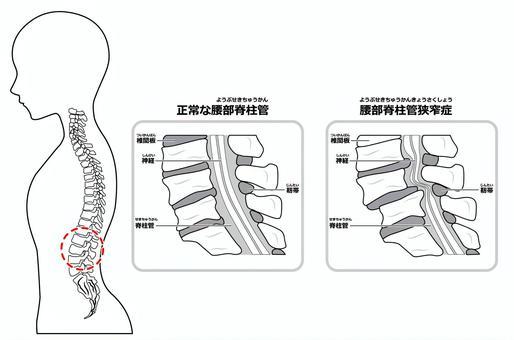腰椎管狹窄症 4 黑白線描, 脊柱管狹窄症, 腰部脊柱管狹窄症, 脊柱管, JPG, PNG 和 AI