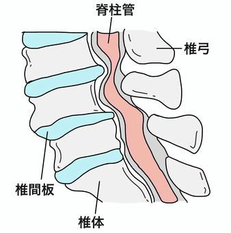 椎管狹窄圖, 脊柱管狹窄症, 麻木, 疼痛, JPG 和 PNG